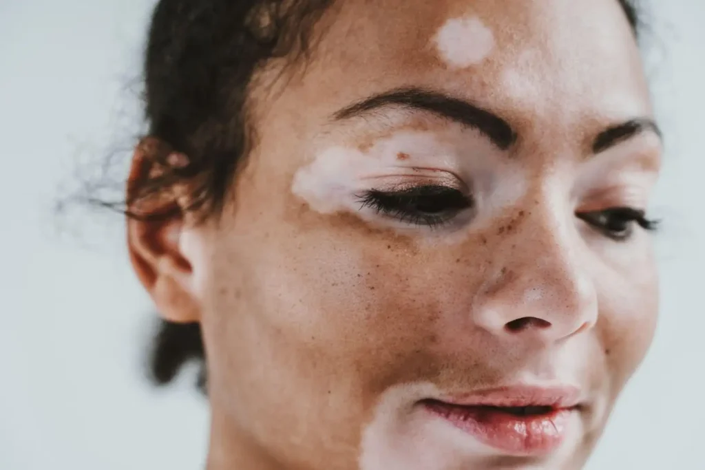 Vitiligo Treatment Plan