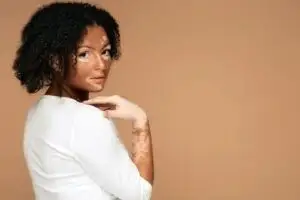 Know about Vitiligo Surgery