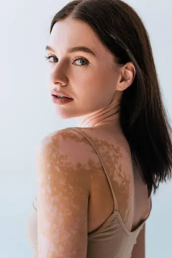 Repigmentation of Skin