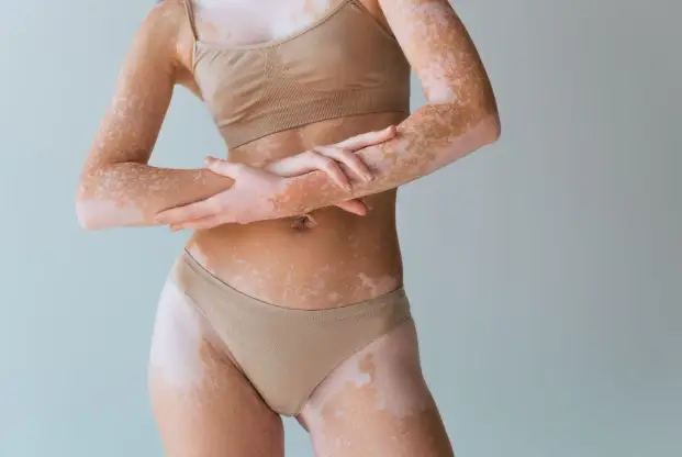 Excimer Laser Treatment for Vitiligo