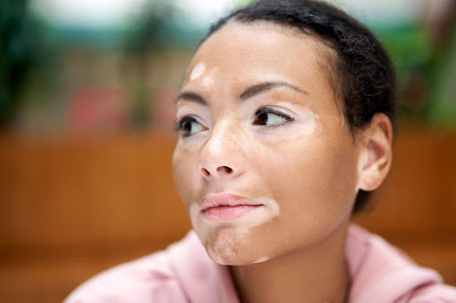 Strategy About Vitiligo Treatment