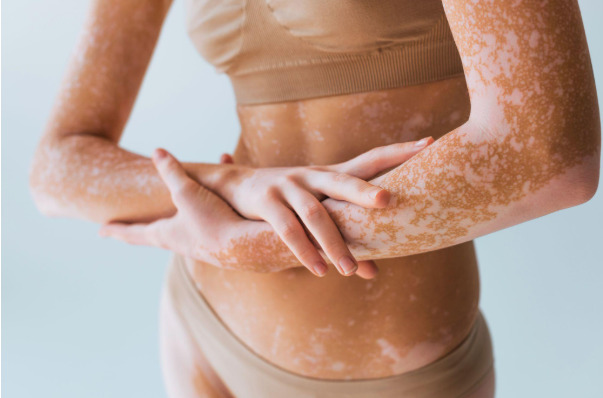 Advanced Vitiligo Treatment