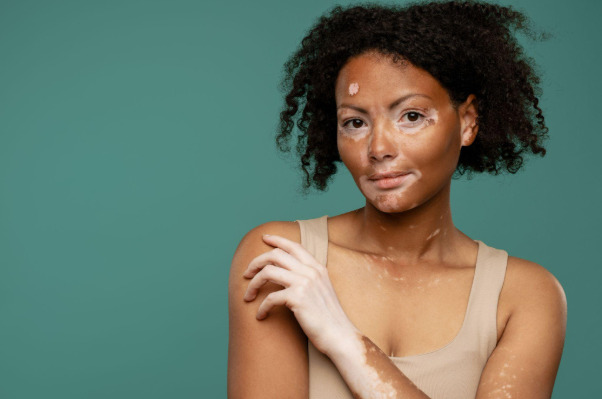 What is Vitiligo?
