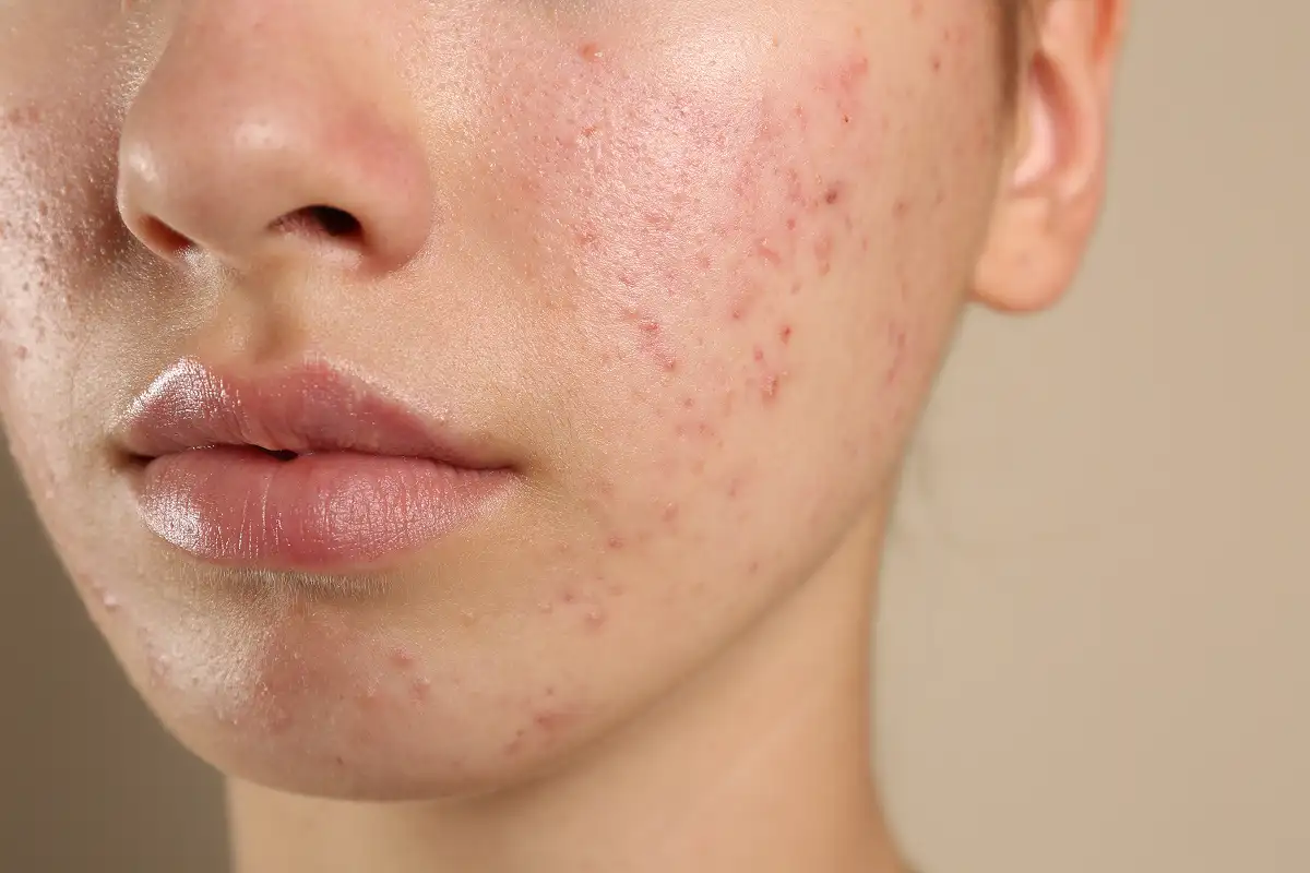 Rosacea