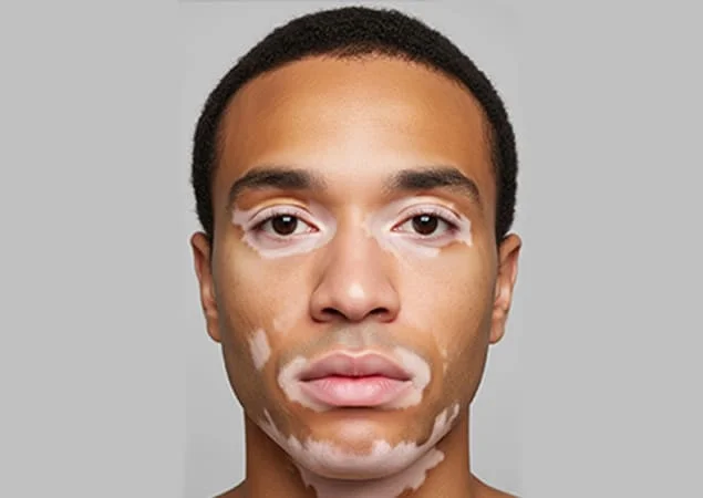 Vitiligo-before-1