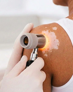Reputed Skin Doctor for Vitiligo