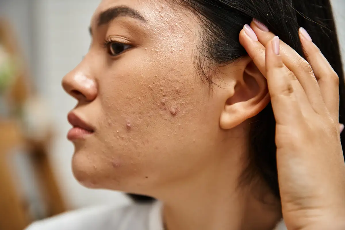 Anti-Acne Treatment in Newtown
