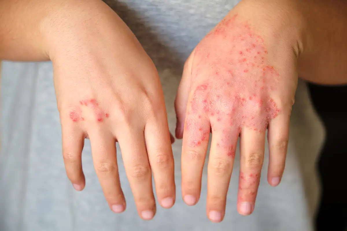 Eczema