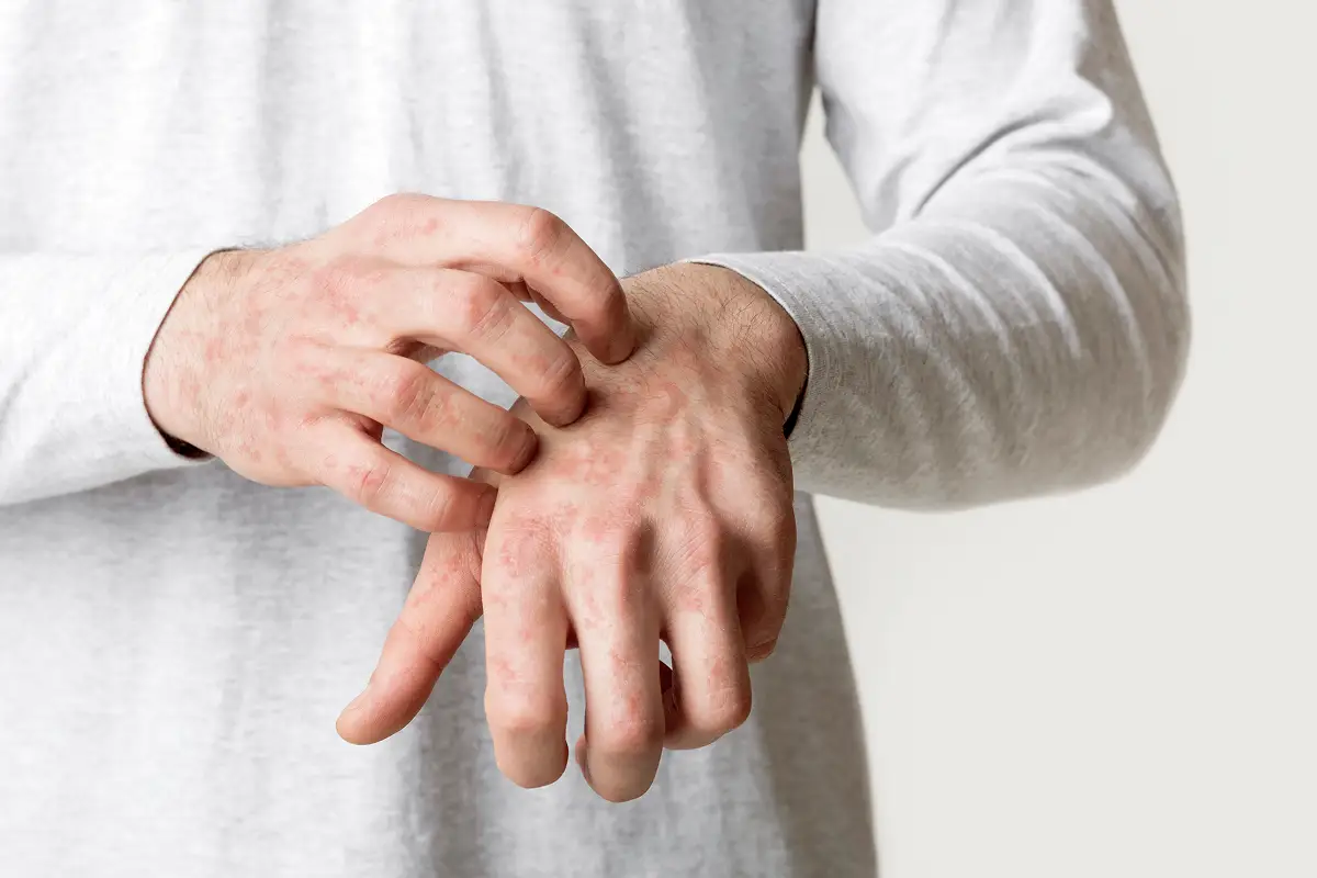 Eczema Treatment in Newtown