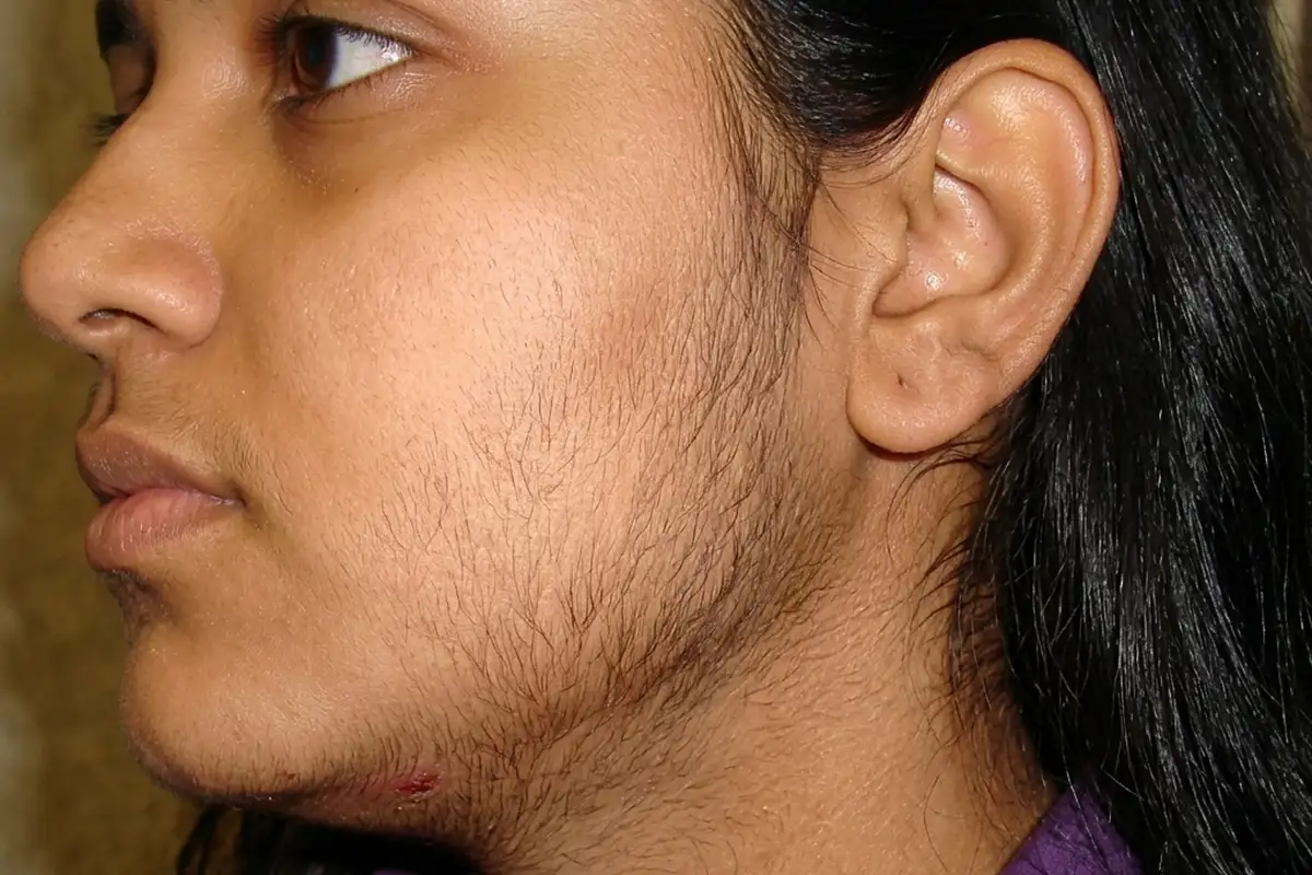 Hirsutism Treatment in Newtown