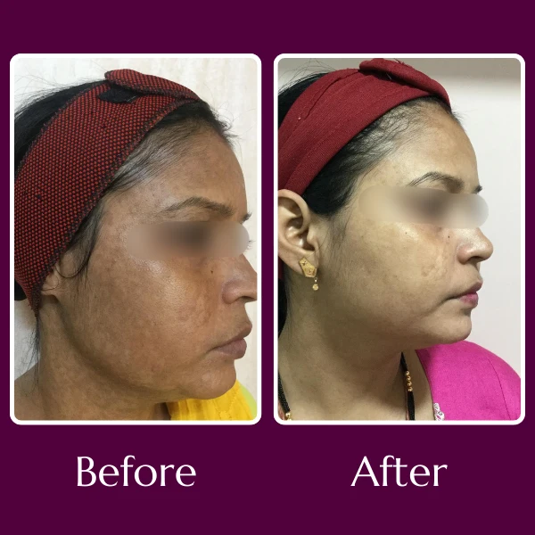 Hyperpigmentation