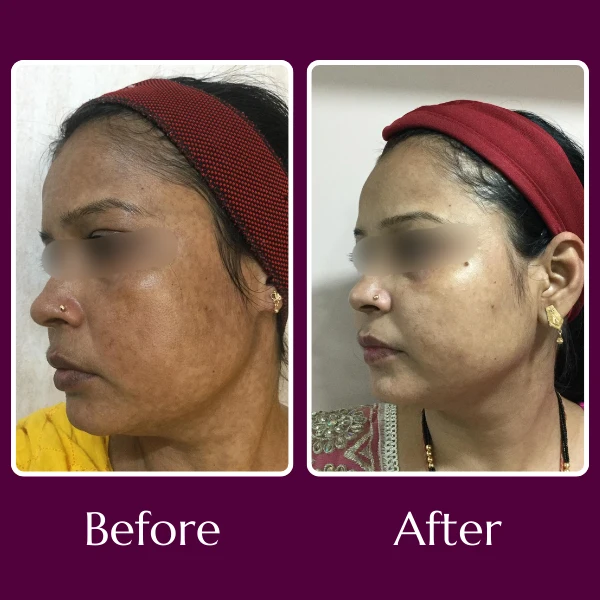 Hyperpigmentation