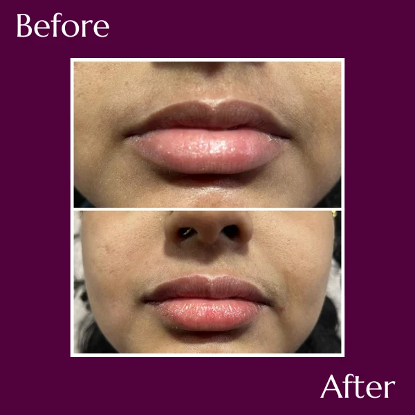 Lip Fillers