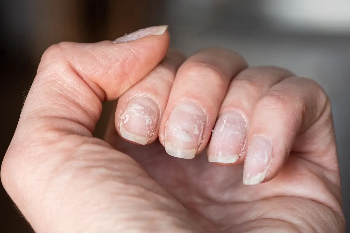 Nail Disorders