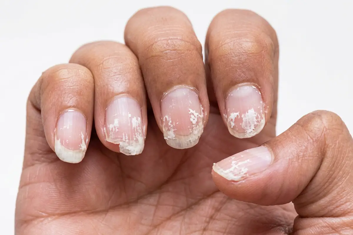 Nail Disorders Treatment in Newtown