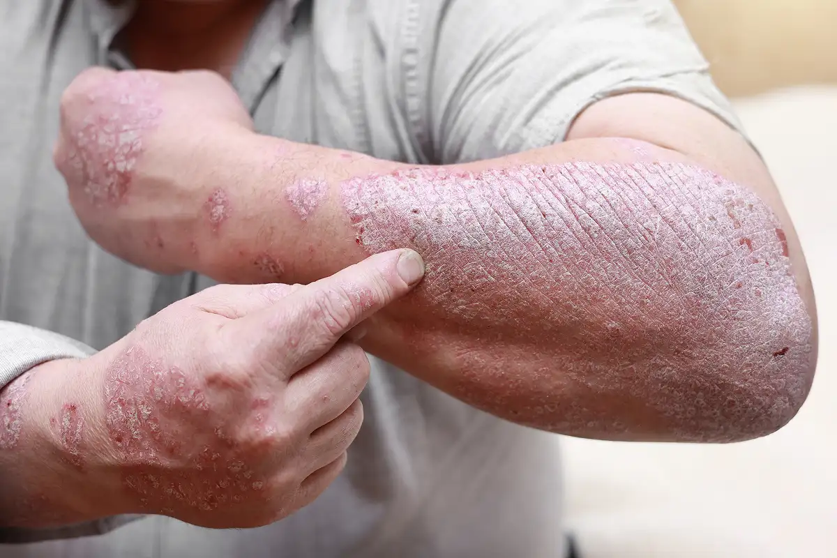 Psoriasis
