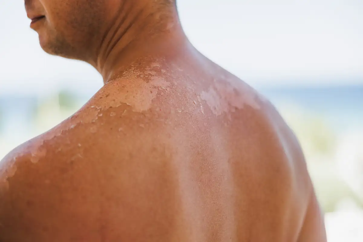 Sun Damage/Age Spots