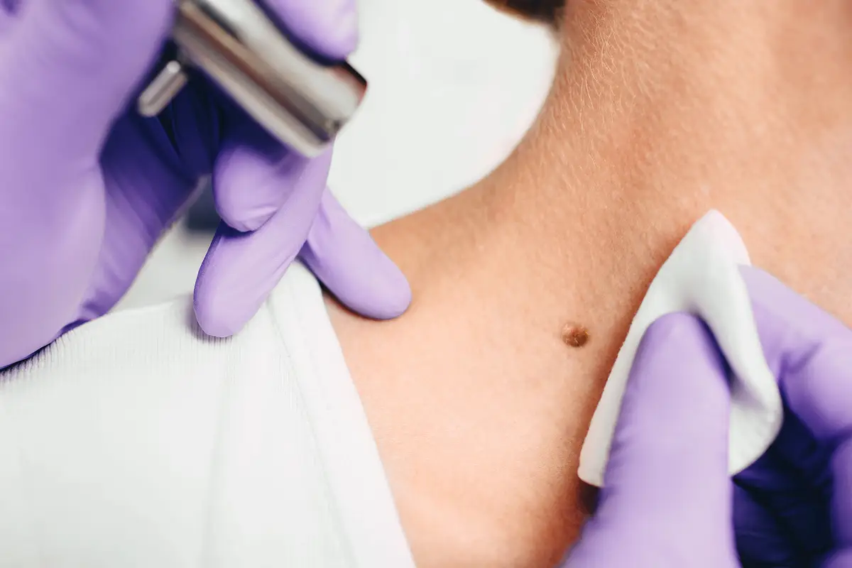 Wart Removal in Newtown