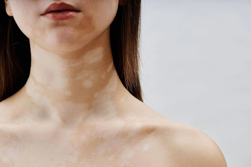 Affect of Vitiligo in Skin Pigmentation