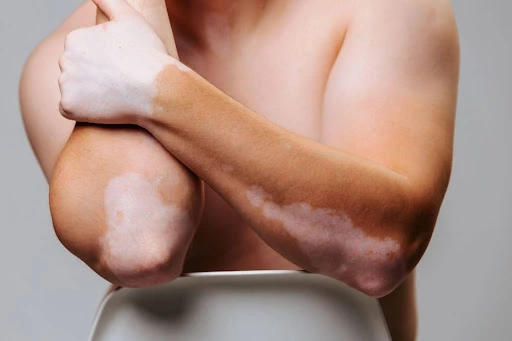 Vitiligi Repigmentation