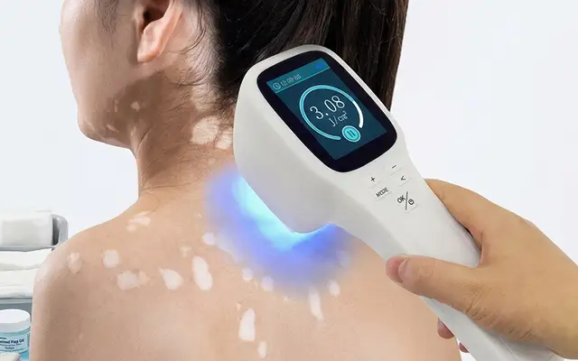 Truth About Excimer Laser for Vitiligo