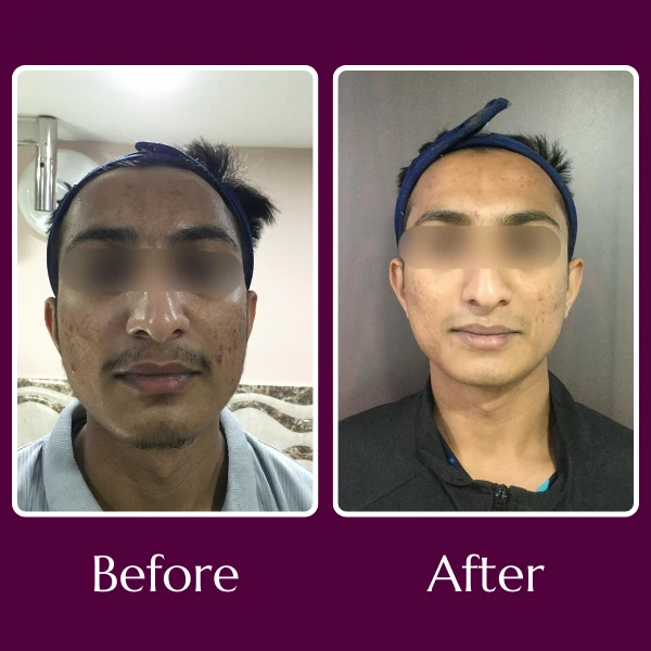 Acne Scars Treatment