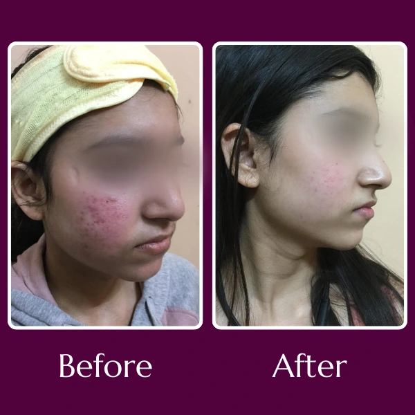 Acne Scars Treatment