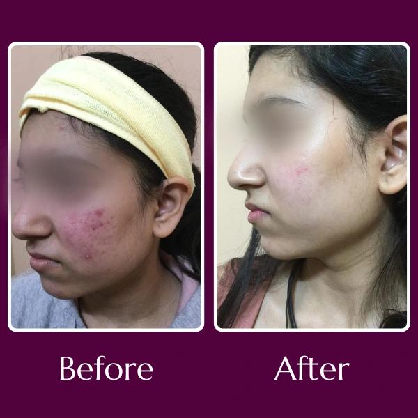 Acne Scars Treatment