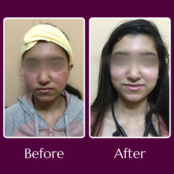 Acne Scars Treatment