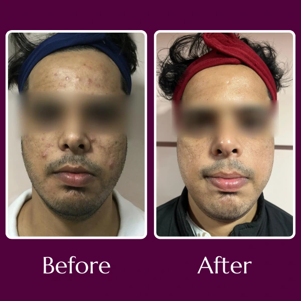 Acne Scars Treatment