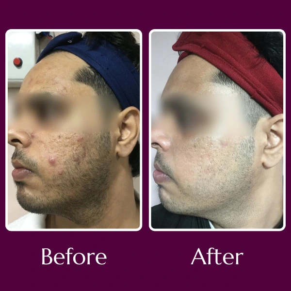 Acne Scars Treatment