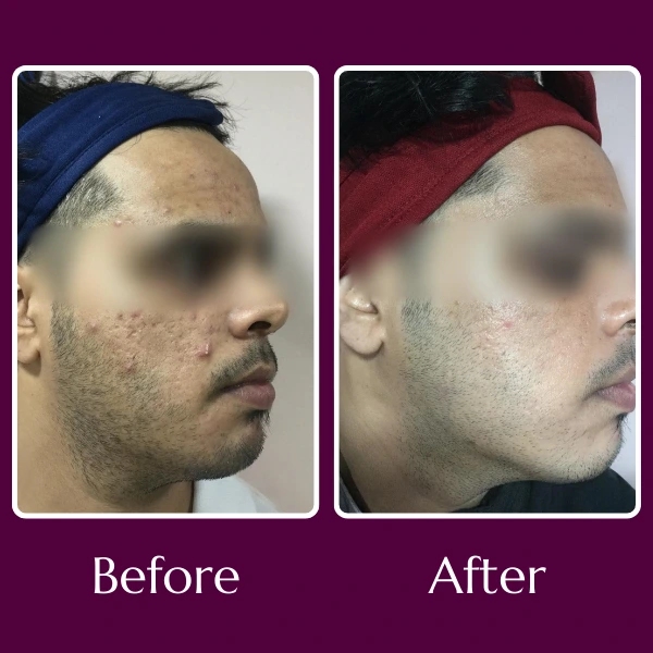 Acne Scars Treatment