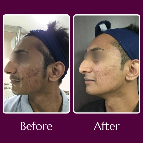 Acne Scars Treatment