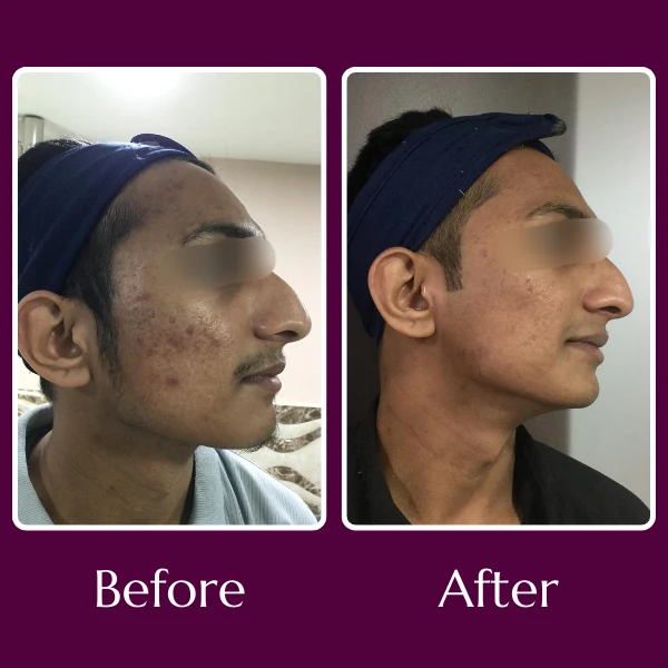 Acne Scars Treatment