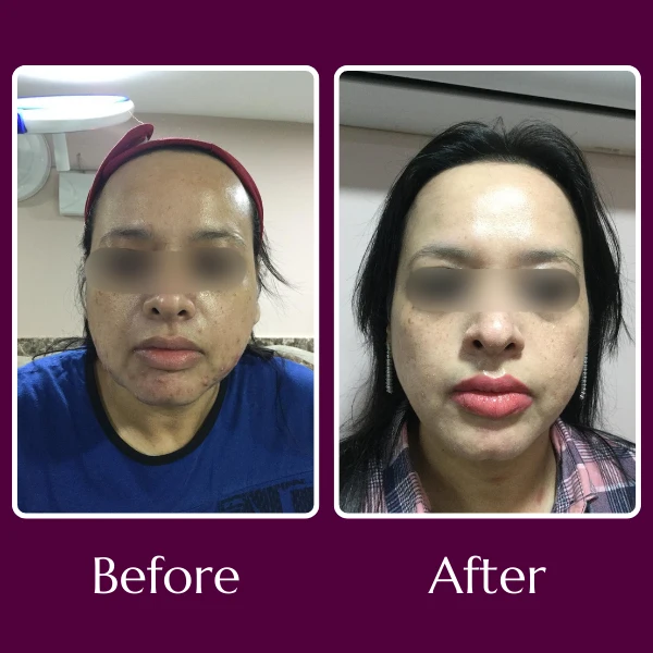 Acne Scars Treatment