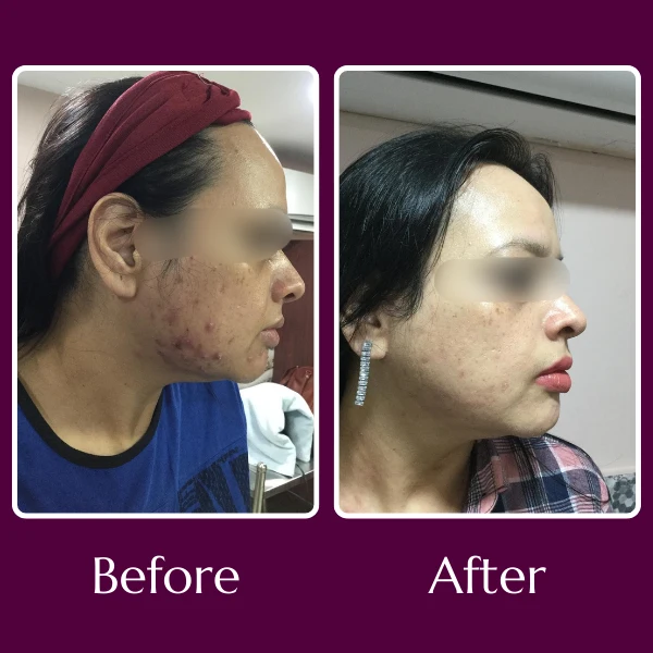 Acne Scars Treatment