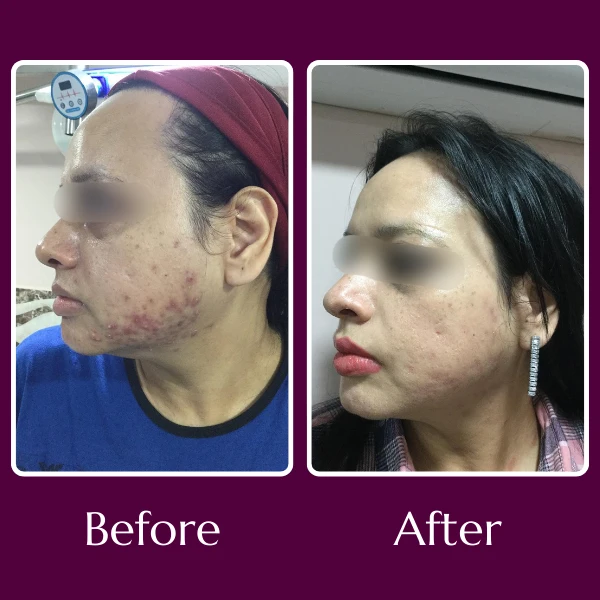 Acne Scars Treatment
