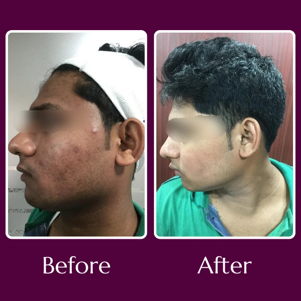Acne Scars Treatment