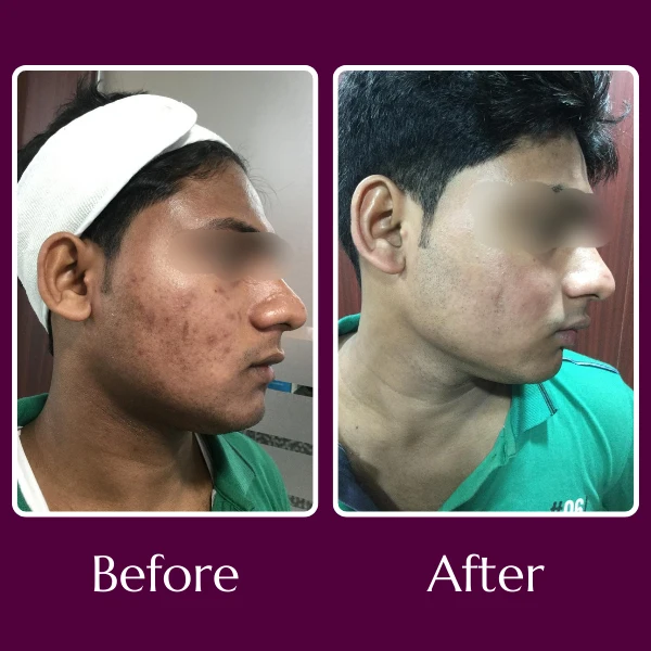 Acne Scars Treatment