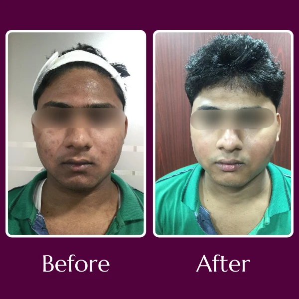 Acne Scars Treatment