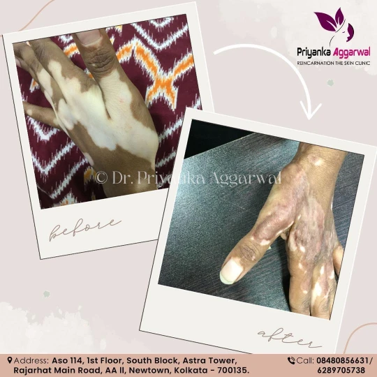 Vitiligo Treatment