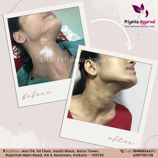 Vitiligo Treatment
