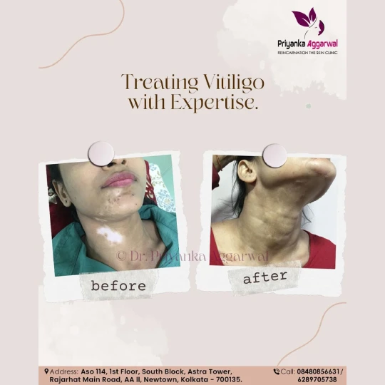 Vitiligo Treatment