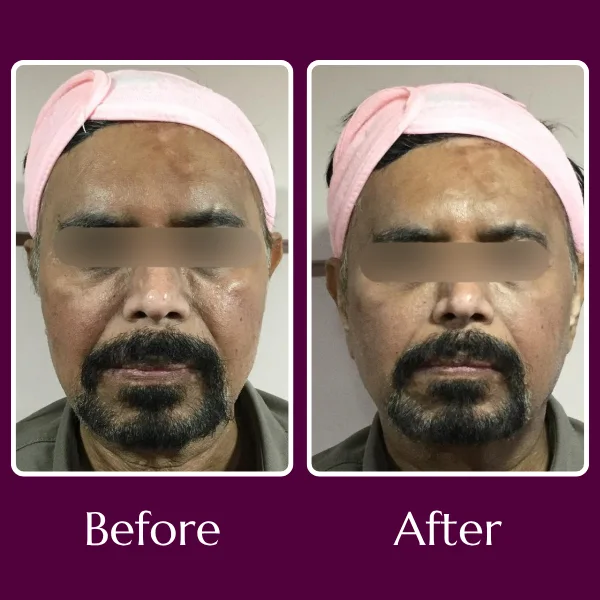 Botox