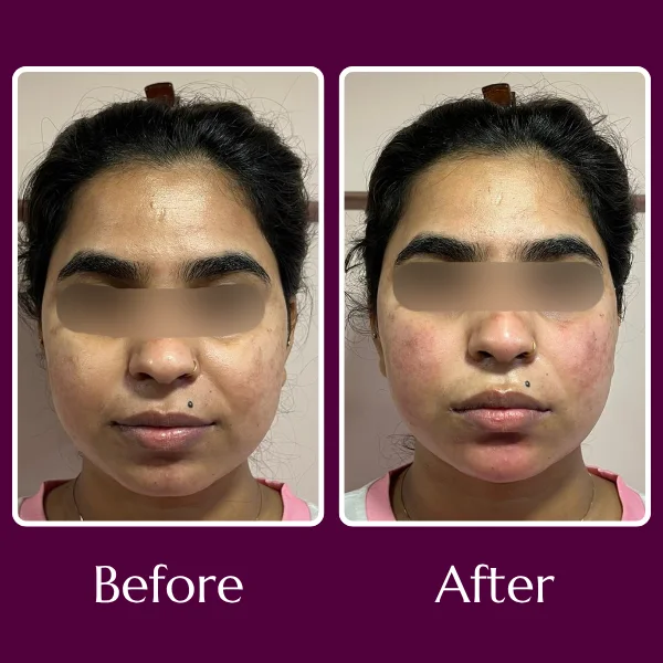 Botox