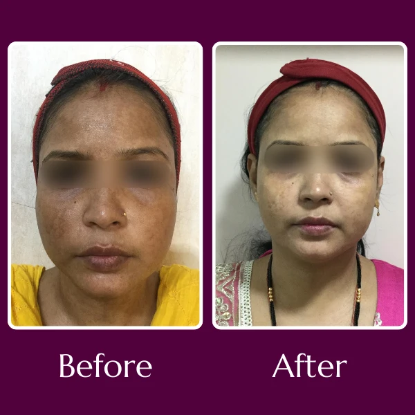 Hyperpigmentation