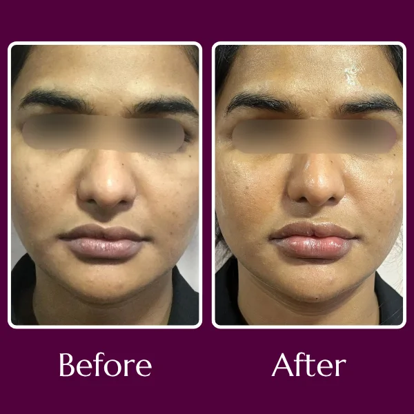 Lip filler