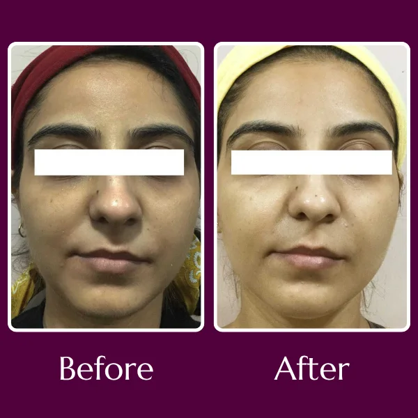 Micro Needling