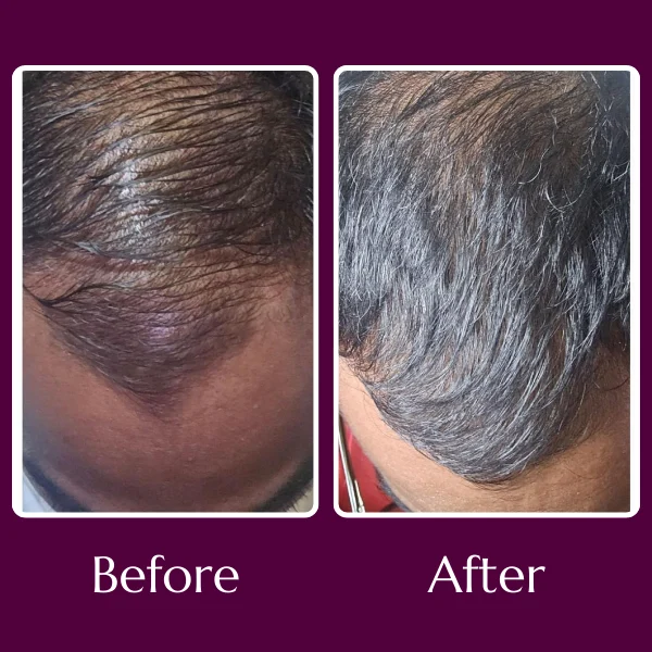 PRP Treatments