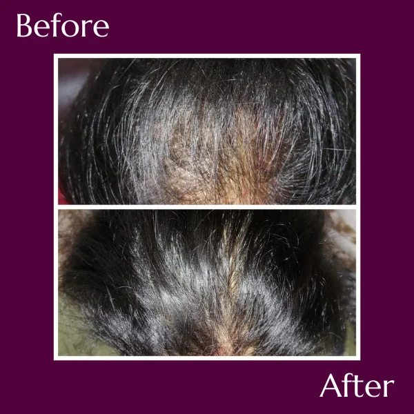 PRP Treatments